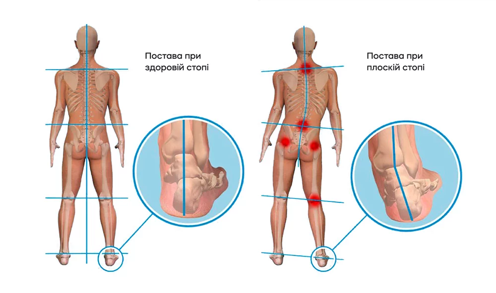 Як покращити поставу?