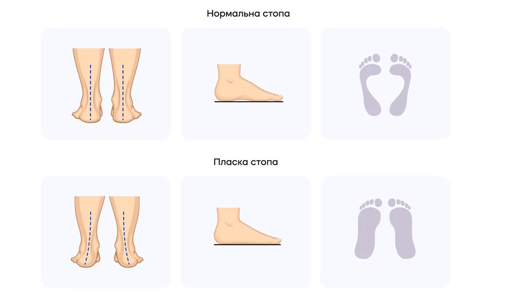 Деформація стопи
