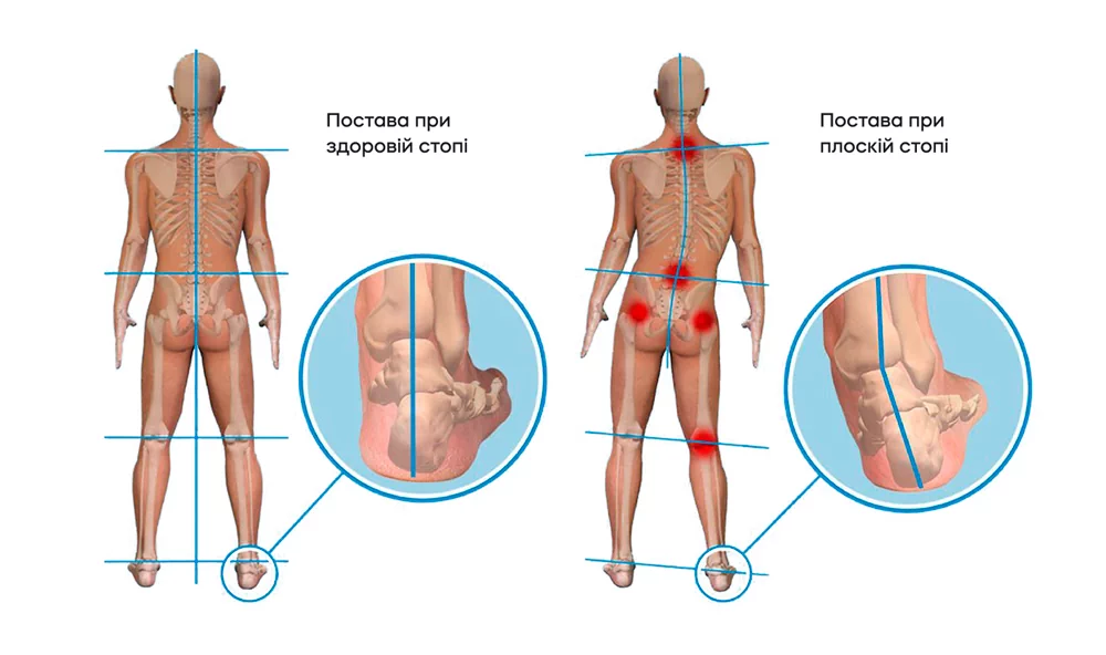 Чим небезпечна плоскостопість?